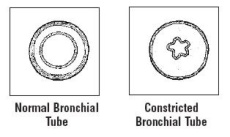Normal Bronchial Tube and Constricted Bronchial Tube