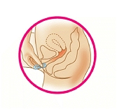 Diagram of a properly twisted Femring being inserted into the vagina