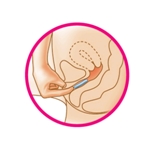 Diagram of the inserted Femring being pushed into the vagina with an index finger