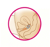 Diagram of a Femring properly inserted into the vagina