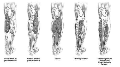 Figure 3: Injection Sites for Adult Lower Limb Spasticity