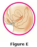 Place the tip of the ring in the vaginal opening. Use your index finger to push the folded ring gently into your vagina. Push it up towards your lower back as far as you can (See Figure E).