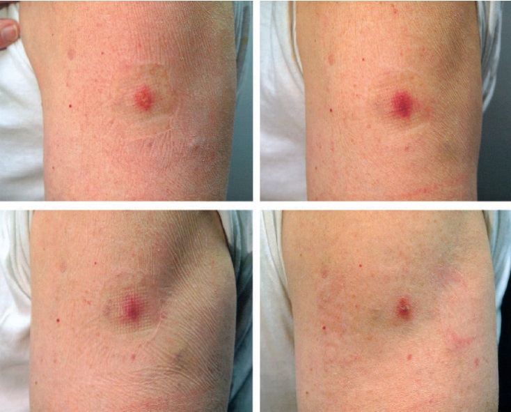 Images of the expected cutaneous reaction from Day 3 to Day 14 after revaccination showing modified (reduced) reaction compared to primary vaccination.