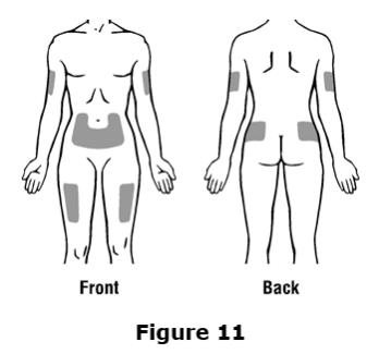 Do not inject Epogen into an area that is tender, red, bruised, hard, or has scars or stretch marks.  Recommended sites for injection are shown in Figure 11 below, including: ○ The outer area of the upper arms ○ The abdomen (except for the 2-inch area around the navel) ○ The front of the middle thighs ○ The upper outer area of the buttocks