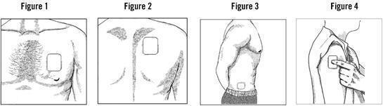 Patch on chest, back, flank or upper arm. Figure 1-4