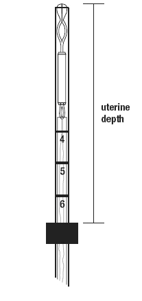 Figure 4. Setting the flange to the uterine depth