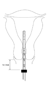 Figure 5. Advancing insertion tube until flange is 1.5 to 2 cm from cervical os