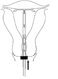  Figure 7. Mirena in the fundal position