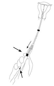 Figure 8. Releasing Mirena from the insertion tube