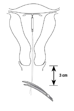 Figure 9. Cutting the threads 