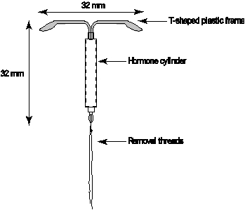 Schematic drawing of Mirena 