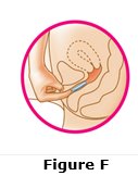 If the ring feels uncomfortable, you may not have pushed the ring into your vagina far enough. Use your index finger to push the ring as far as you can into your vagina (See Figure F). 