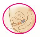 Femring should now be in your upper vagina (See Figure G). The exact position of Femring in the vagina is not important for it to work.