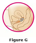 Femring should now be in your upper vagina (See Figure G). The exact position of Femring in the vagina is not important for it to work.