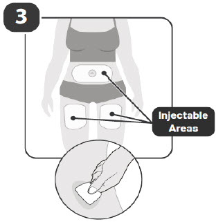 image of injectable areas - instructions for use