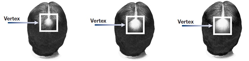 Minoxidil Vertex Image