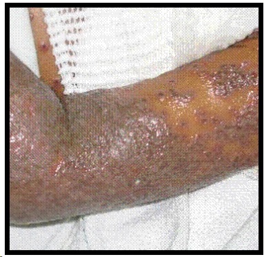 MedGuide Image 1 infected arm.jpg