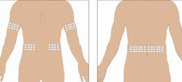 Select the number of infusion sites depending on the volume of the total dose.  See administration for recommended maximum volumes and rates. Potential sites for infusion include the back of arms, abdomen, thighs, and lower back (see Figure below).  Ensure sites are at least 2 inches apart; avoid bony prominences.