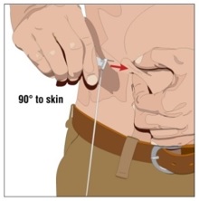 Choose the correct needle length to assure that GAMMAGARD LIQUID is delivered into the subcutaneous space.  Grasp the skin and pinch at least one inch of skin between two fingers.   Insert needle at a 90 degree angle with a darting motion into the subcutaneous tissue.  Secure the needle.