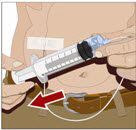 Prior to the start of infusion, check each needle for correct placement to make sure that a blood vessel has not been punctured.  Gently pull back on the attached syringe plunger and monitor for any blood return in the needle set.