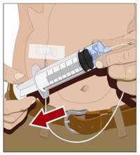 Prior to the start of infusion, check each needle for correct placement to make sure that a blood vessel has not been punctured.  Gently pull back on the attached syringe plunger and monitor for any blood return in the needle set.