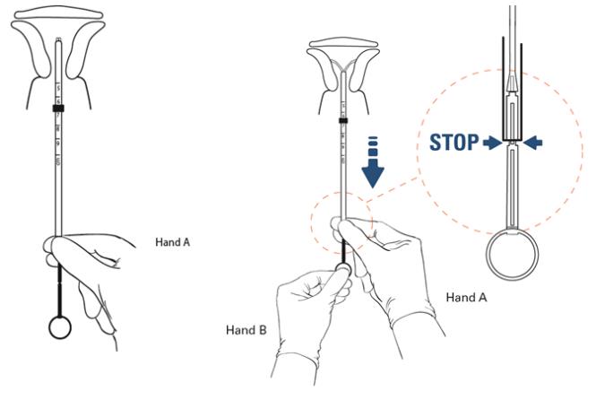 Figure 8:	While holding the rod and the tube, advance into the uterine cavity.
Advance to 1.5 – 2.0 cm from the cervix.	

Figure 9:	Hold the rod still and pull back the tube until the second indent on the rod.
