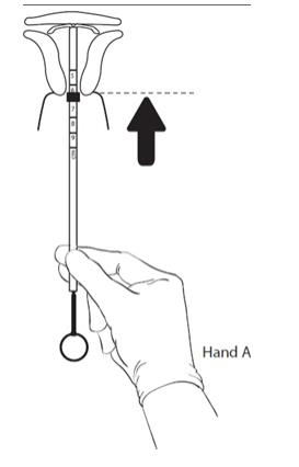 Figure 10:	 After 10 – 15 seconds, advance to the fundus while holding both the rod and the tube.