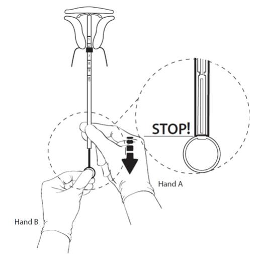 Figure 11:	 Hold the rod still and pull back the tube to the ring on the rod.