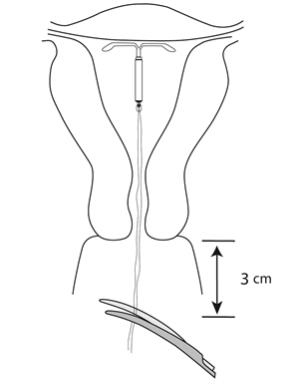 Figure 12:	 Cut the threads about 3 cm from the cervix