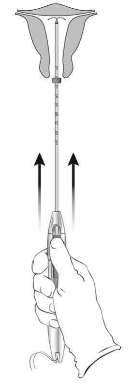 Figure 10:  Move LILETTA into the Fundal Position