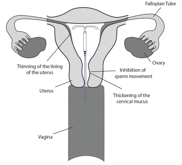 IUD in Uterus