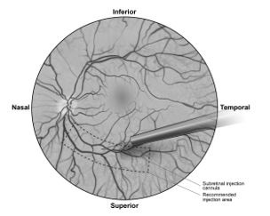 Figure 5b.  Tip of the subretinal injection cannula placed within the recommended site of injection (surgeon’s point of view)