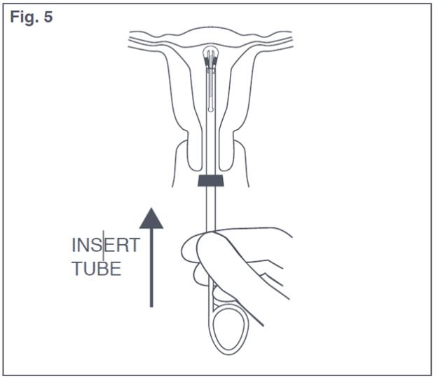 Figure 5: Insertion Tube with Paraguard in Uterus