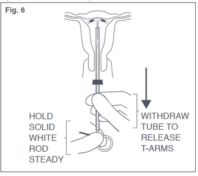 Figure 6: Release of T-Arms of Paraguard in Uterus 