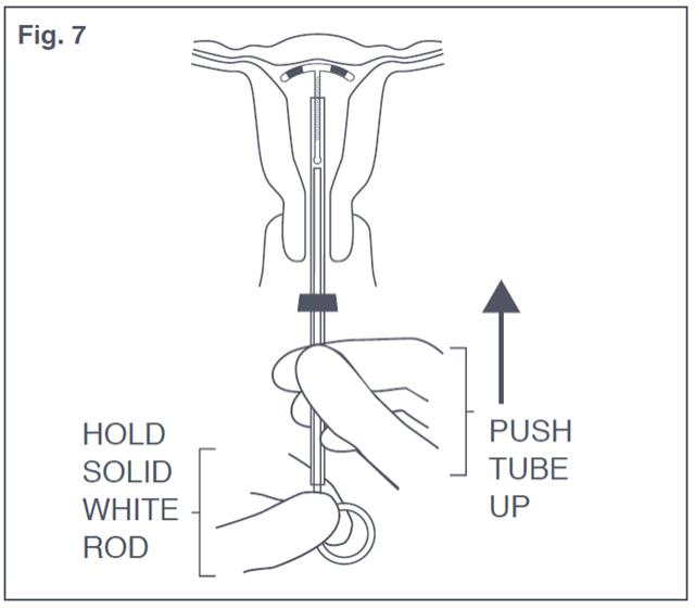 Figure 7: Placement of Paraguard in Fundus of Uterus 