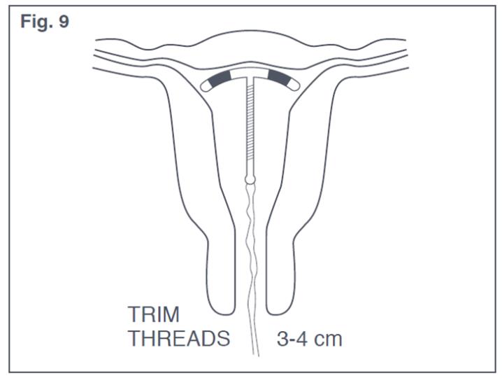 Figure 9: Appropriate Paraguard Placement in Uterus 