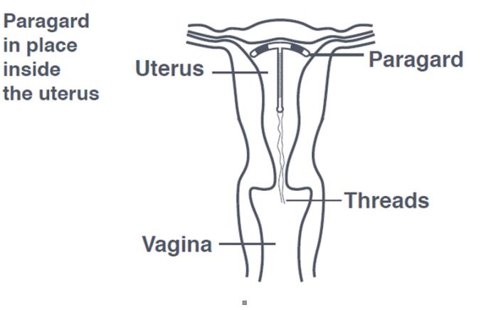 Paragard in place inside the uterus. 