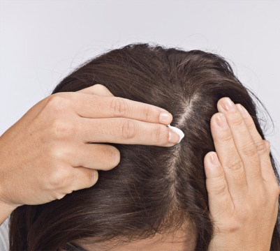 Apply Sorilux to dry scalp