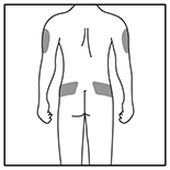 Back Injection Areas